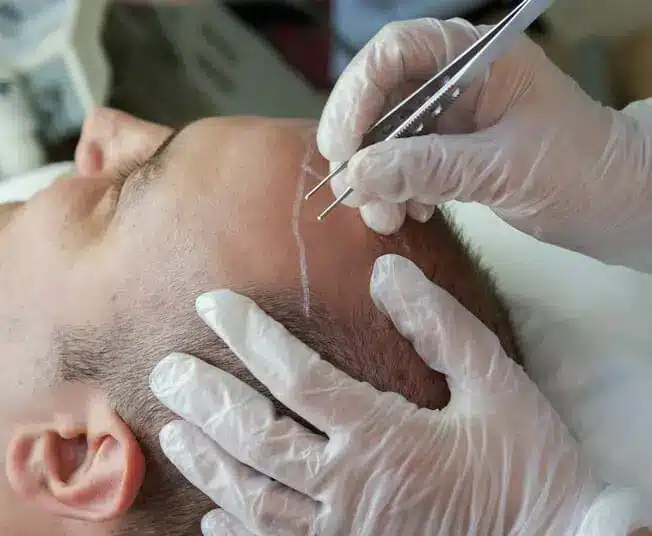 The surgical process of a hair transplant