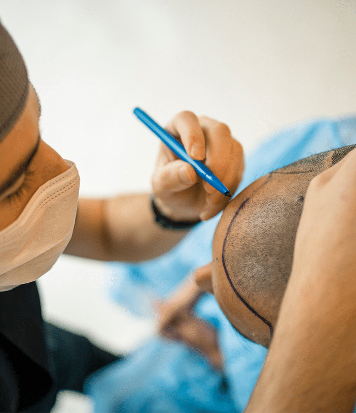 hair surgeon performing hair transplant procedure on a male patient